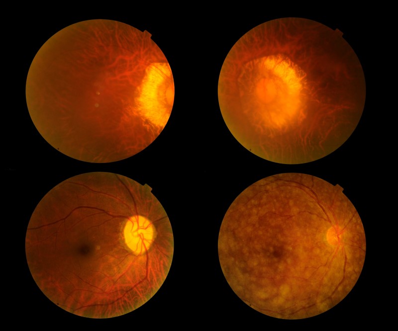 Retina durante l'esame del fondo oculare